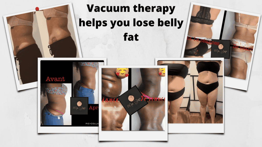 vacuum therapy belly